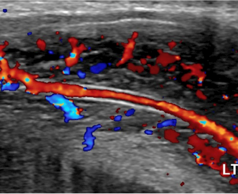 The role of Doppler ultrasound in the evaluation of penile haemodynamics